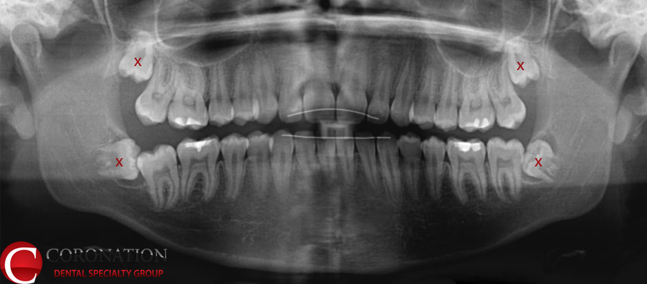 Blog Sal: Pengalaman cabut gigi bongsu - Q&A / Tips