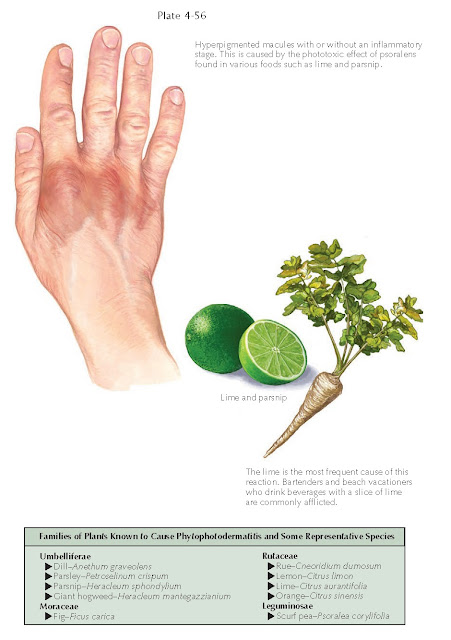 PHYTOPHOTODERMATITIS