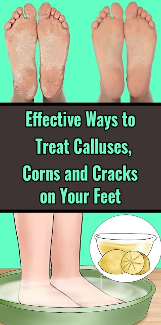 Effective Ways to Treat Calluses, Corns and Cracks on Your Feet
