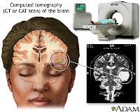 Brain Ct Scan1