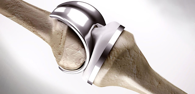 Bone Replacement Products