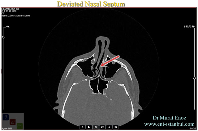 Deviated Nasal Septum Surgery,Septoplasty operation in Istanbul,Nasal Septum Correction Surgery,