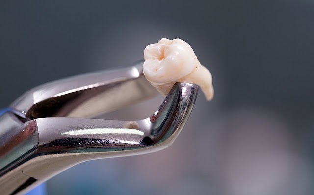 Morte de mulher após extração de dente na Bahia acende alerta; saiba quando há riscos