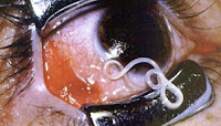 19 cm long worms live in the Eye of This Man