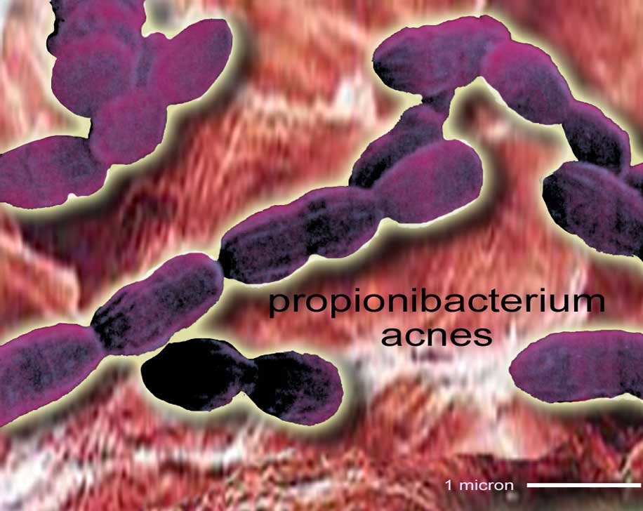 MAKALAH BAKTERI PROPIONIBACTERIUM ACNES Yazhid Blog