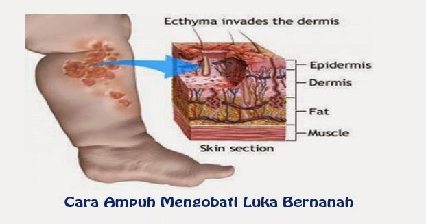 Cara Mengobati Luka yang Bernanah