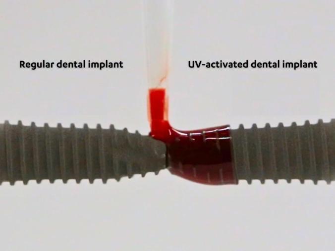 ADIÓS A LA PERIIMPLANTITIS: Investigadores de la Facultad de Odontología de la UCLA desarrollan una tecnología de implantes revolucionaria