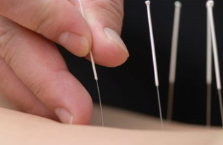 Acupuncture benefits