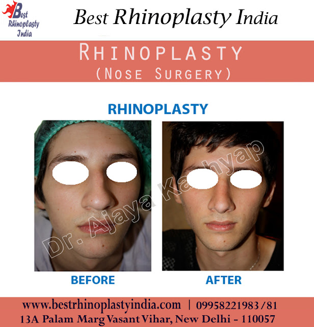 rhinoplastysurgery,  nosesurgery, nosejob, rhinoplasty surgeon cost, nose surgery, rhinoplasty  surgery delhi, nose surgeon india, best rhinoplasty clinic south delhi, septorhinoplasty 