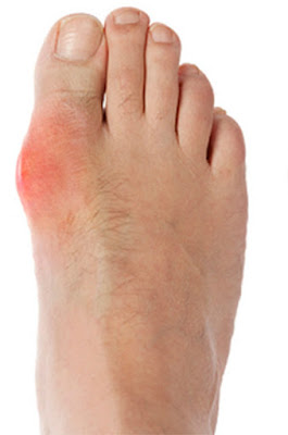 juanetes hallux valgus