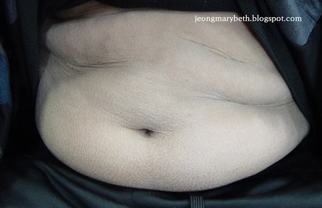 Acquired Ichthyosis (4) Image