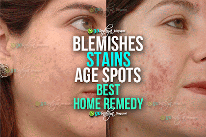 Best ever home remedy to remove blemishes, dark spots and age spots