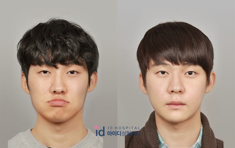 アジア最初の輪郭専門病院 韓国id美容外科です Id美容外科 男性美容整形 男子美容整形 男美容整形 両顎手術 ルフォー アジア最初の輪郭専門病院 韓国id美容外科です Id美容外科 男性美容整形 男子美容整形 男美容整形 両顎手術 ルフォー