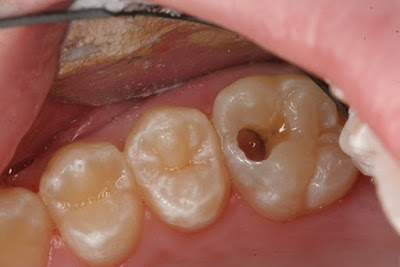 Dấu hiệu nhận biết răng bị sâu đến tủy