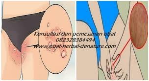 cara mengobati gatal,obat gatal atau eksim,obat eksim,cara menghilangkan gatal pada tangan,cara menghilangkan gatalk pada kaki