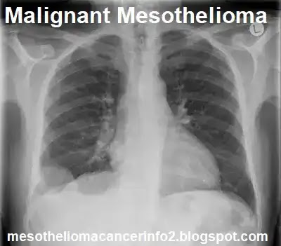 Here Is What You Should Do For Your CARE FOR MESOTHELIOMA PATIENTS