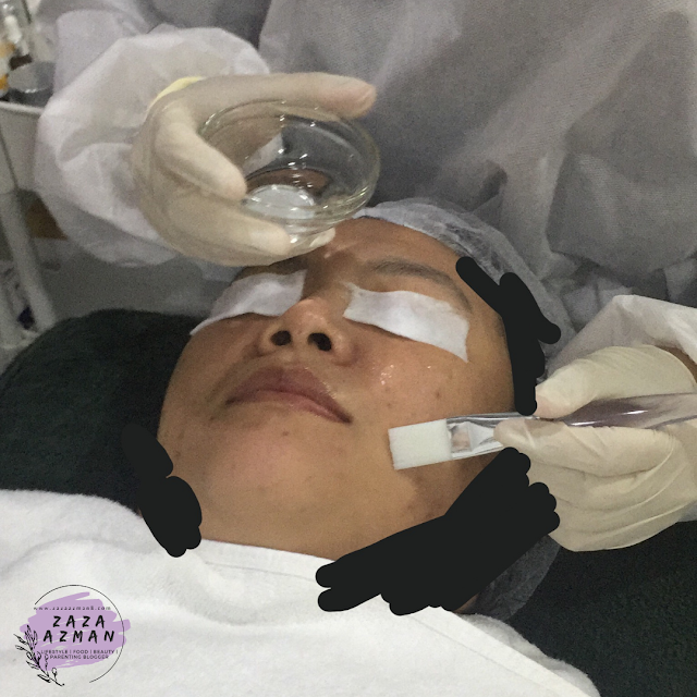 Dermalene Chemical Peel Pigmentation Treatment