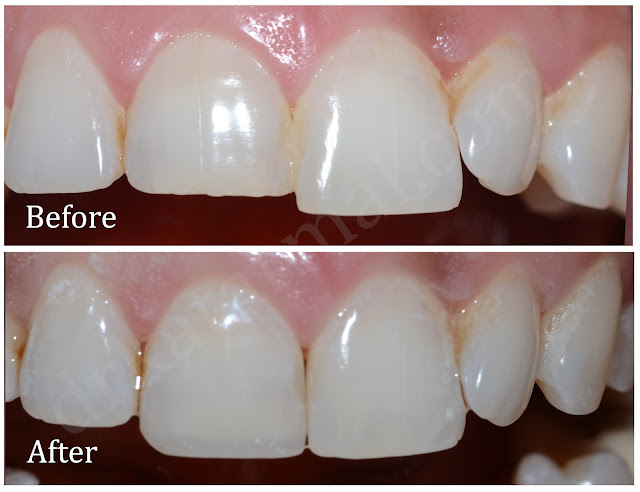 Treatment for Front Short Tooth with Composite Buildup
