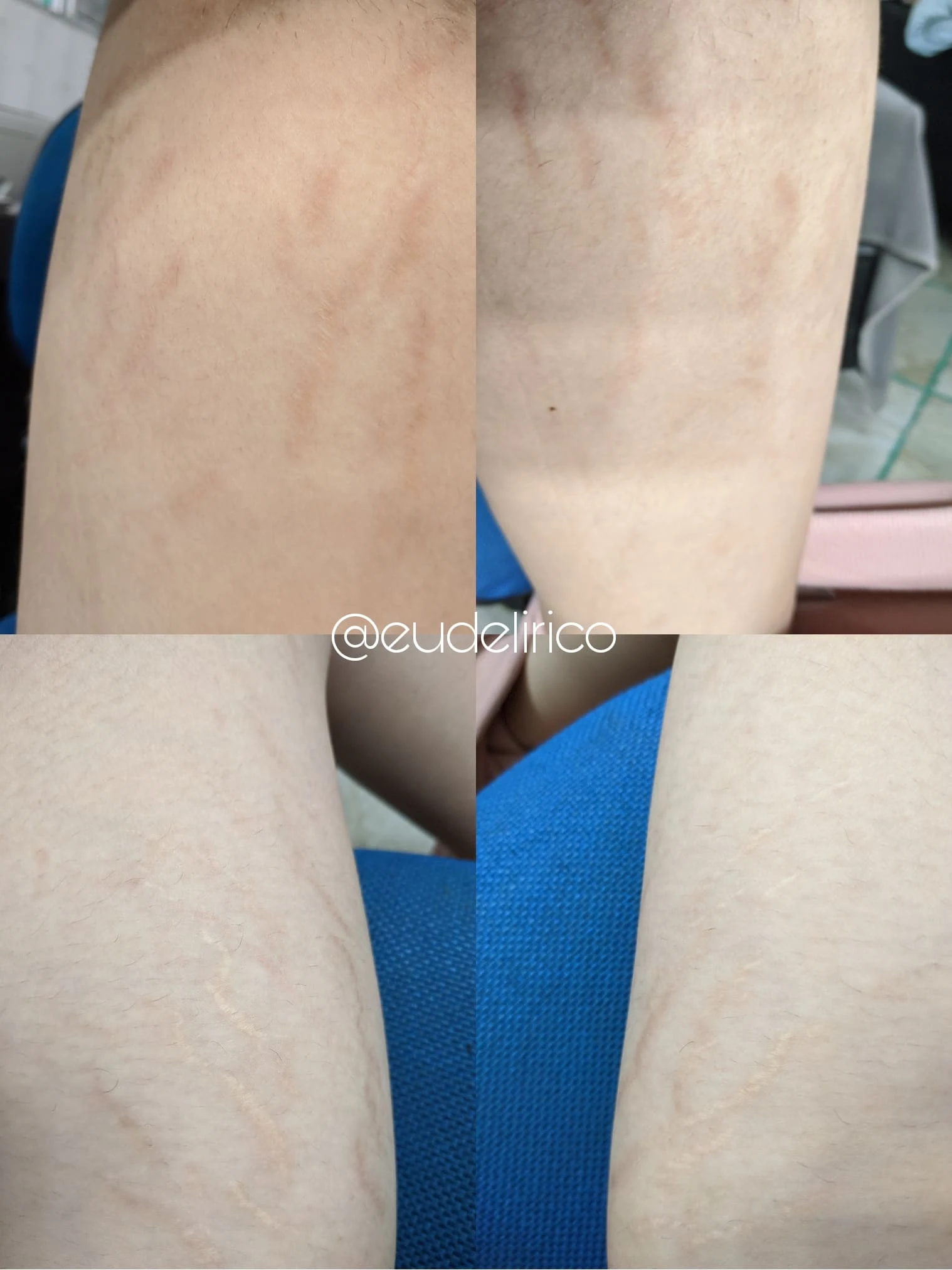 antes e depois cicatricure gel cicatrizes e estrias