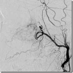leiomyoma 3