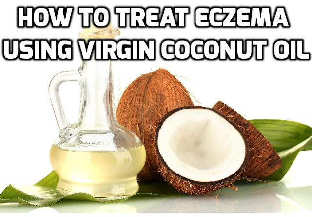 Coconuts are commonly found in the tropics. It is the source of virgin coconut oil which is hailed for its medicinal properties, including as an effective eczema treatment. Read on to find out more.