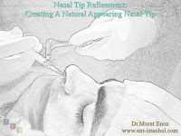 Current Concepts in Nasal Tip Plasty,Patient Selection for Tipplasty,How to Create Natural Nasal Tip?,Creating A Natural-Appearing Nasal Tip Contour,