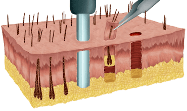 FUE Hair Transplant