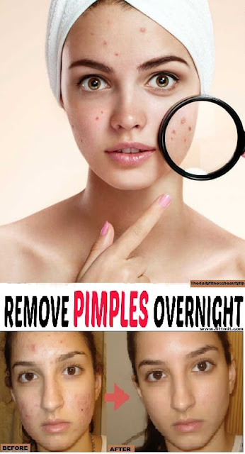 Pimple-removal-remedy