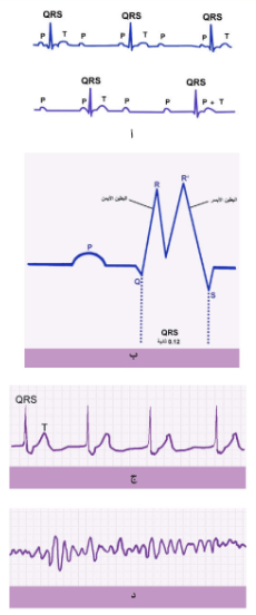 الشكل 16-18: تخطيط قلب كهربائي لمرضى لديهم: أ) انسداد توصيل جزئي أو كلي، ب) انسداد توصيل في أحد فرعي حزمة هس حيث يعطي موجة QRS مشقوقة، ج) احتباسة، د) لييفية البطين.