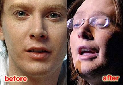 nicki minaj before and after plastic surgery pics. Clay Aiken efore and after