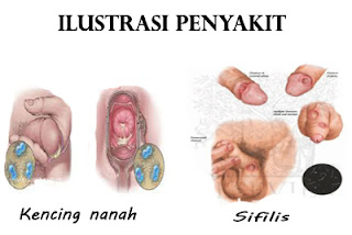 obat sipilis alami sangat ampuh 3 hari sembuh