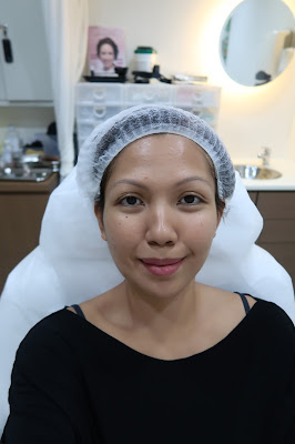 carbon laser facial