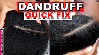 Dandruff Flakes Removal and Dandruff Treatment | DiscoveringNatural