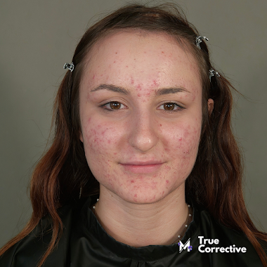 Case Study: Chiara TC19 • Master Class di Make Up Online su Acne Cistica (da agosto)