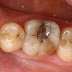 Quy trình chữa bệnh răng sâu tại nha khoa