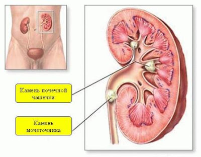 камни в почках