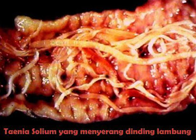 Taenia Solium menyerang dinding lambung