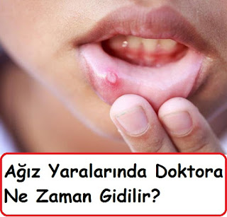 Ağız Yaralarında Doktora Ne Zaman Gidilir