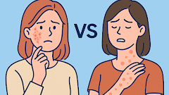 알레르기성 피부염 vs 두드러기 차이점｜가려움증 원인부터 증상·치료법 비교 정리