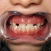 Điều bạn nên biết khi niềng răng cho người bị móm