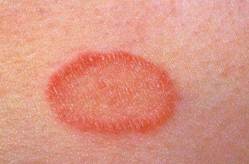 Cara Atasi Kulat Ringworm Di Kulit Kepala - vitaminorganik.com