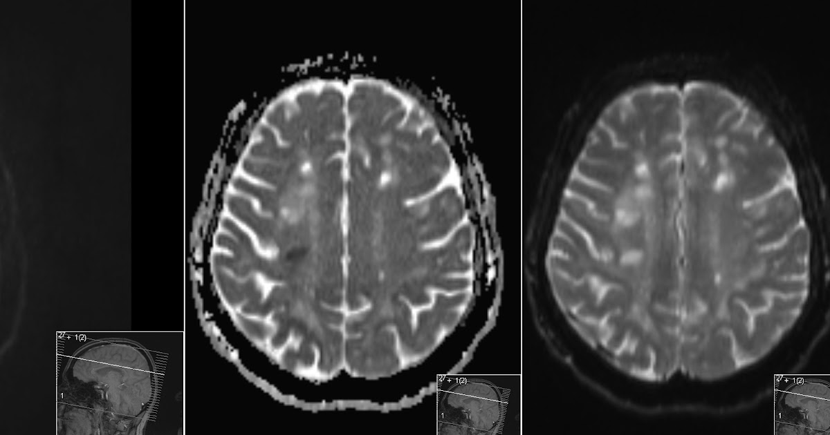 Radiology MRI DWI Restriction in MS