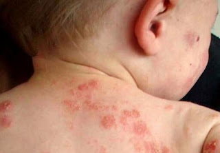 Eczema in Infants