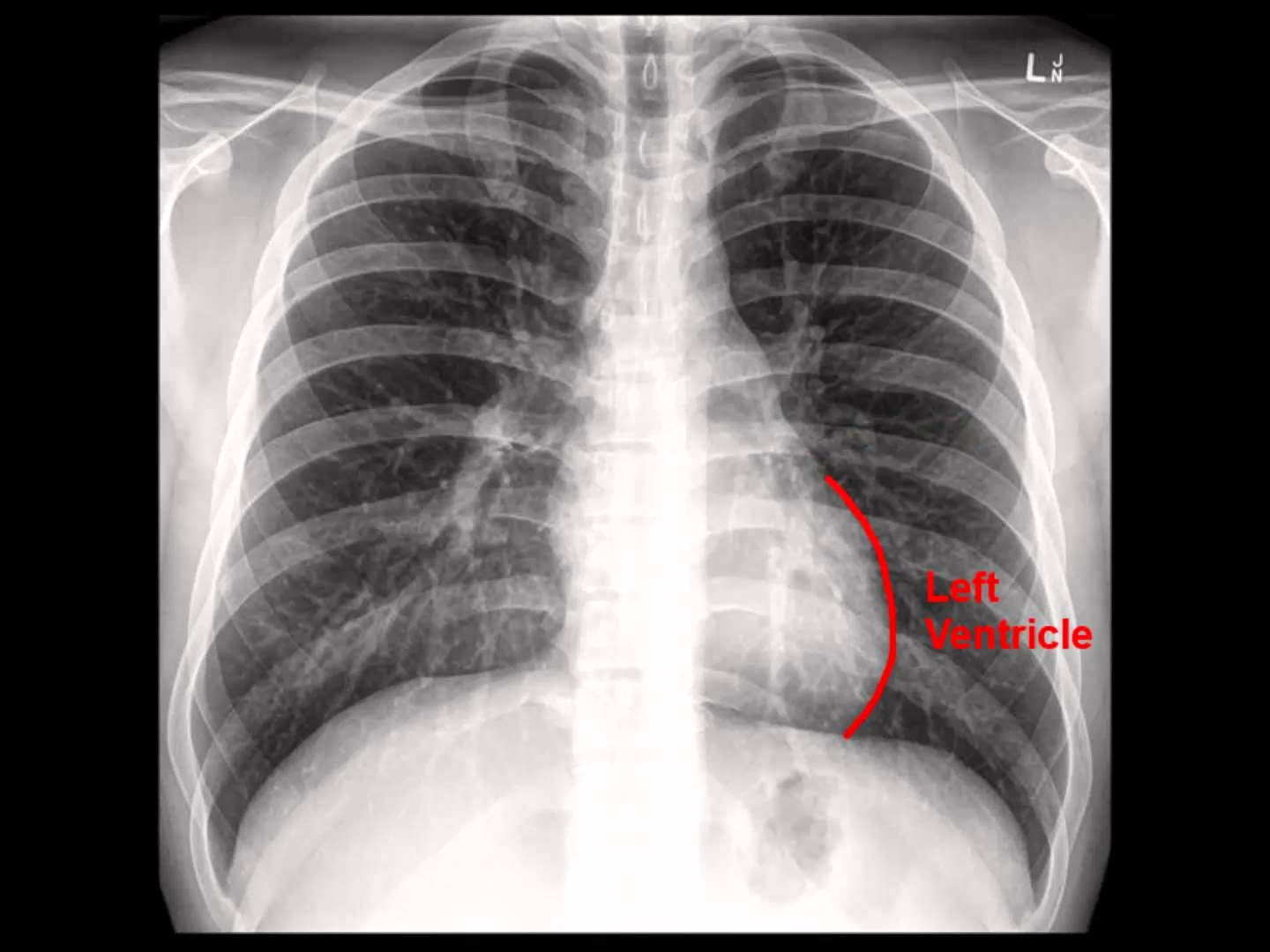 http://pathologyvideos.blogspot.ro/2014/04/chest-x-ray-analysis-in-nutshell.html