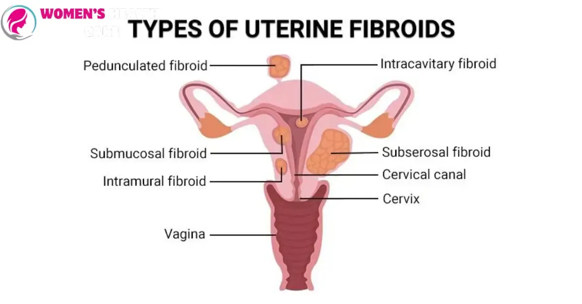 Uterine Fibroids 2024