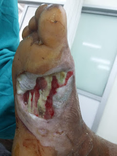 Ulcer over the medial aspect of foot extending into the sole.