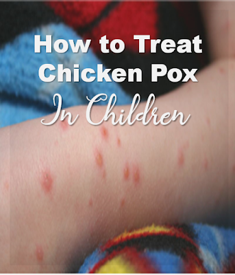 how to treat chicken pox in children