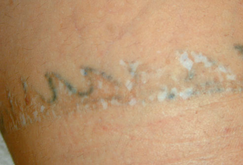 laser tattoo removal.