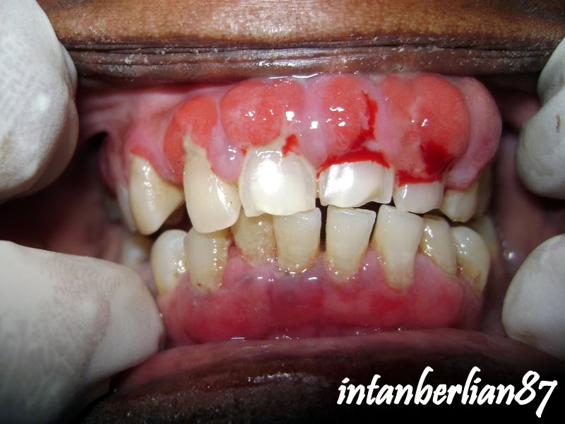 Multiple periodontal abscess in diabetic patient berserta 