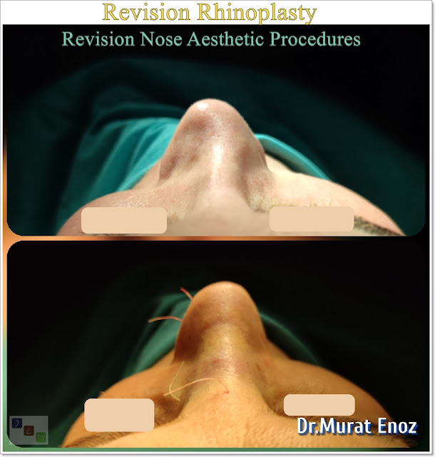 Secondary Nose Job,Revision Rhinoplasty,Revision Nose Aesthetic,Tertiary Nose Job,